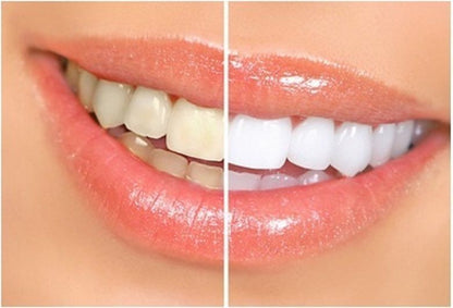 28 Strips Advanced Teeth Whitening Kit for a Brighter Smile